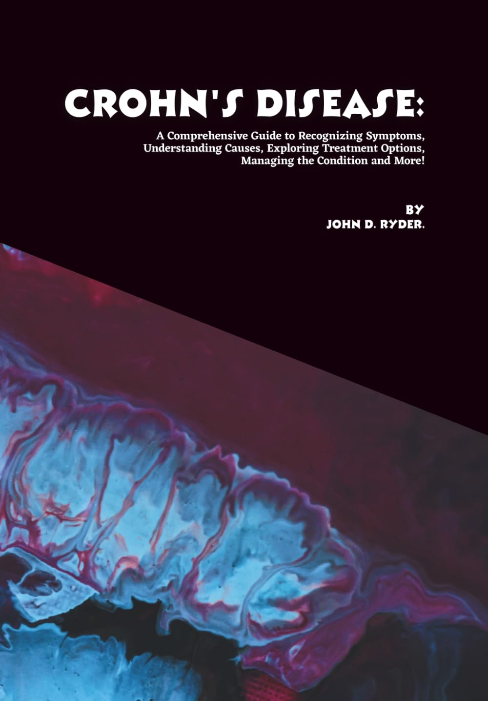 Crohn's Disease: A Comprehensive Guide to Recognizing Symptoms, Understanding Causes, Exploring Treatment Options, Managing the Condition and More!