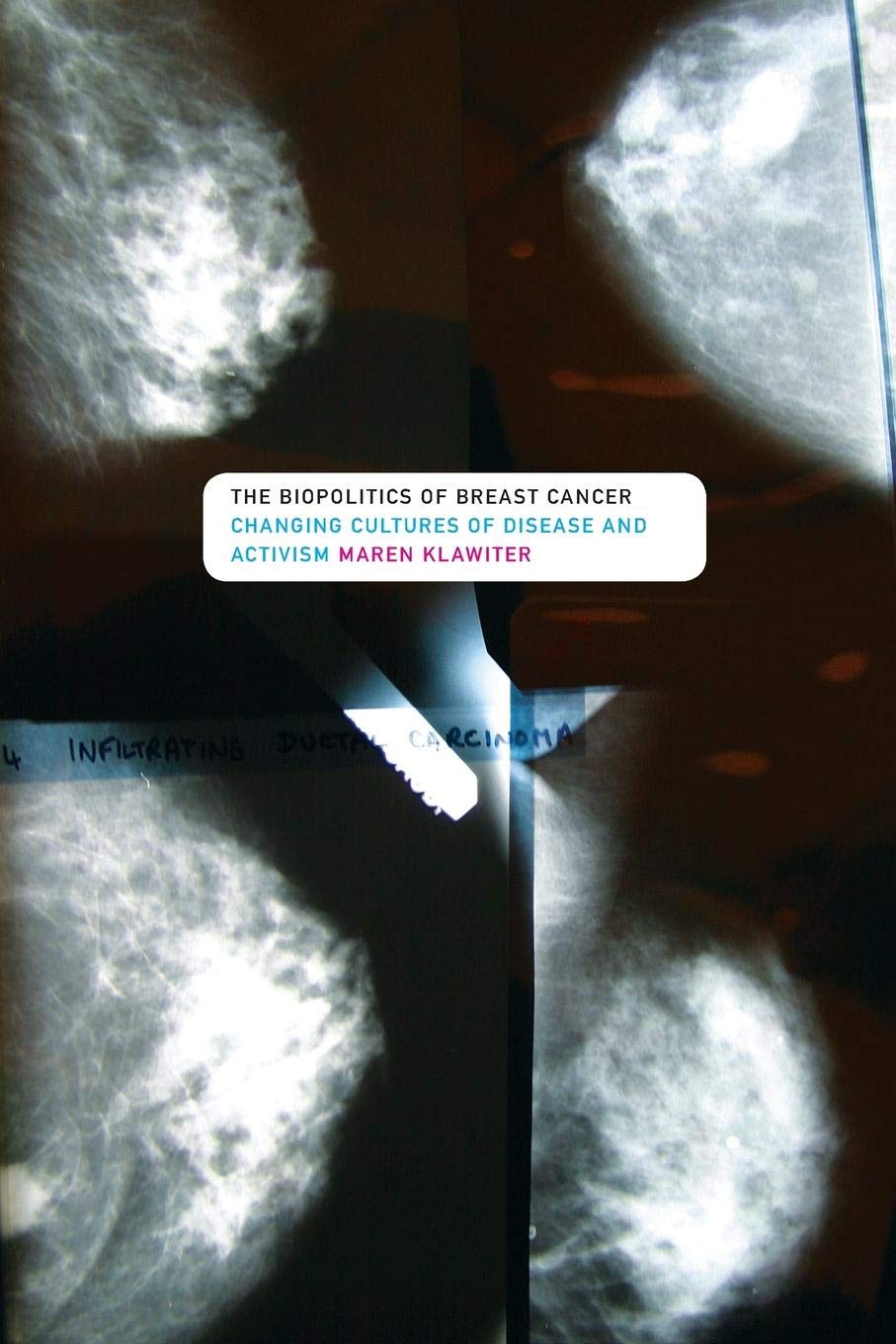 The Biopolitics of Breast Cancer: Changing Cultures of Disease and Activism