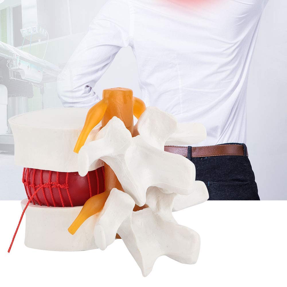 1:1.5 Ernia del disco lombare umano Modello Vertebrale Spine Anatomica Studio Medico Dimostrazione Display Strumento di insegnamento