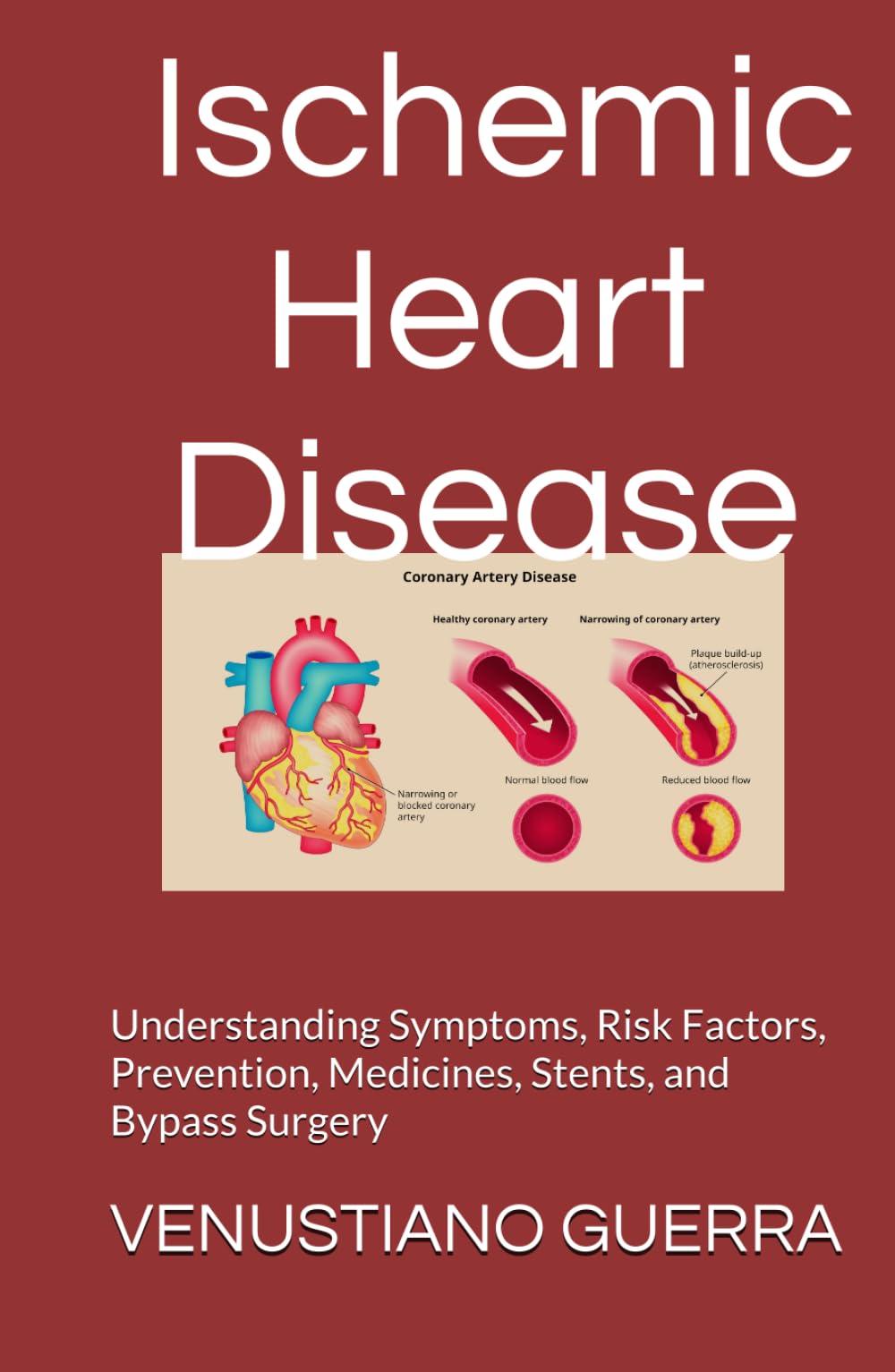Ischemic Heart Disease: Understanding Symptoms, Risk Factors, Prevention, Medicines, Stents, and Bypass Surgery (Medical Publications for lay people)
