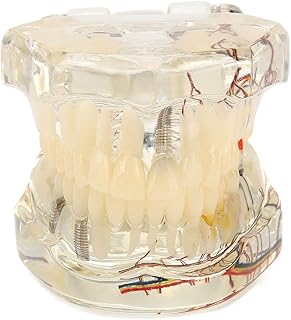 Transparent Dental Implant Pathological Model Dental Teeth Model Implant Disease Teeth Model - Showing Implant Bridging Including 1/4 Veneer Fiber Post Core Implant Bridging