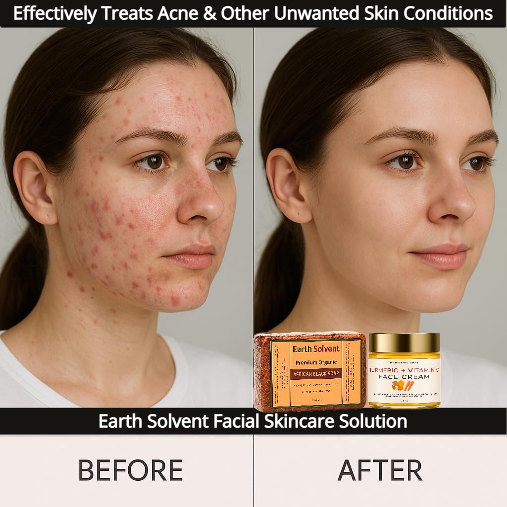 Premium Organic African Black Soap, for Acne Skincare. Pure & Natural Ingredients for All Skin Types - Turmeric Vitamin C Face Cream with Hyaluronic Acid & Kojic Acid (Included)