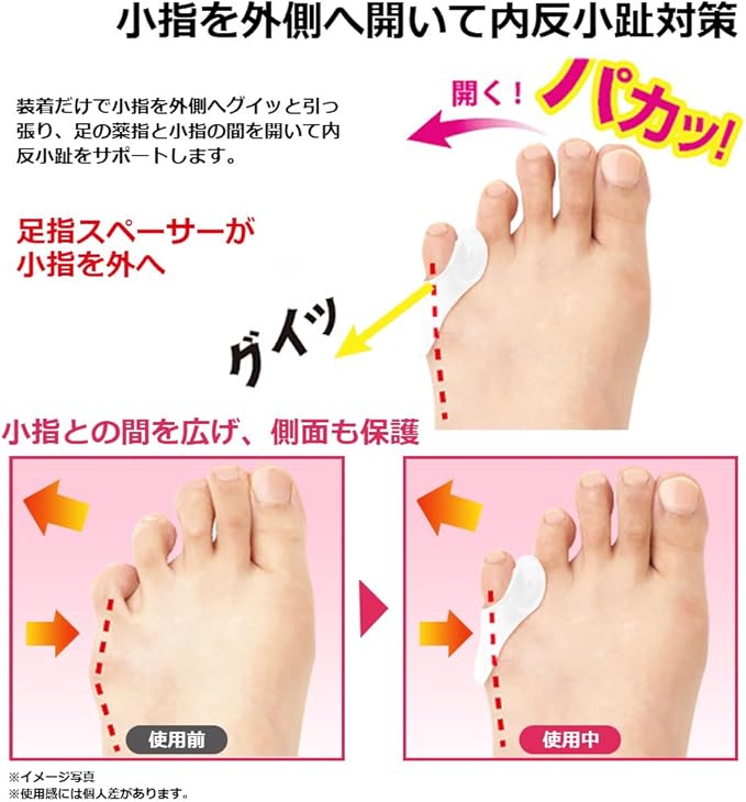 Amazon Toe Glow 内反小趾 サポーター シリコンパッド外反母趾 靴ズレ防止 サポーターグッズ 小指対策 男女兼用 外反母趾 内反母趾用 Amazon Toe Glow 内反小趾 サポーター シリコンパッド外反母趾 靴ズレ防止 サポーターグッズ 小指対策 男女兼用 外反母趾 内反母趾用