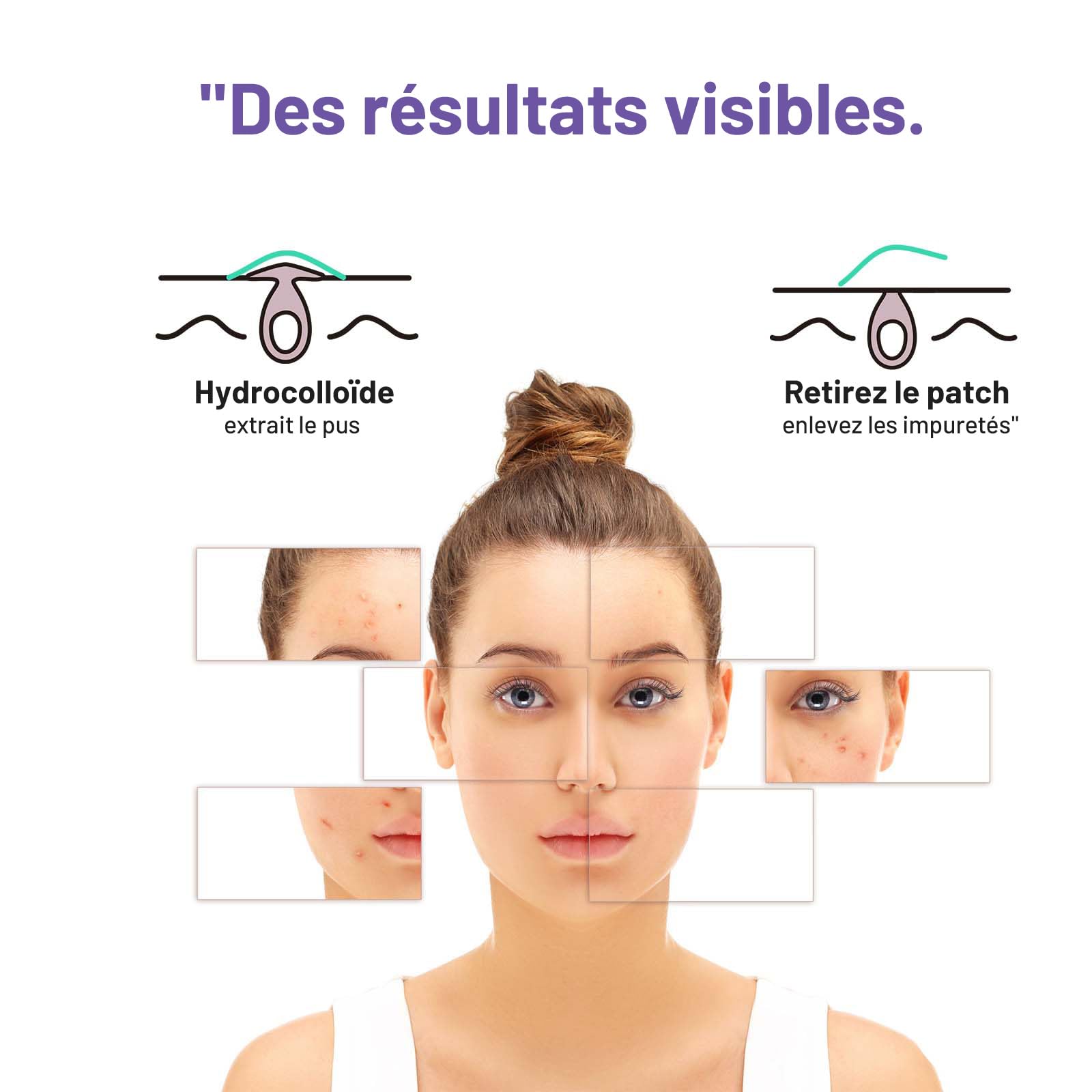 Patchs bouton ACOTYE 32pcs, pimple patch à L'huile d'arbre à thé, acide salicylique à et niacinamide, pour sur le menton, les joues, le dos