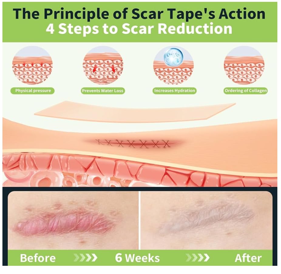 Miniatura 3 de Cinta de silicona para cicatrices, hojas de silicona de grado médico, 1.6 x 60 pulgadas, paquete de 2 unidades, tratamiento profesional de