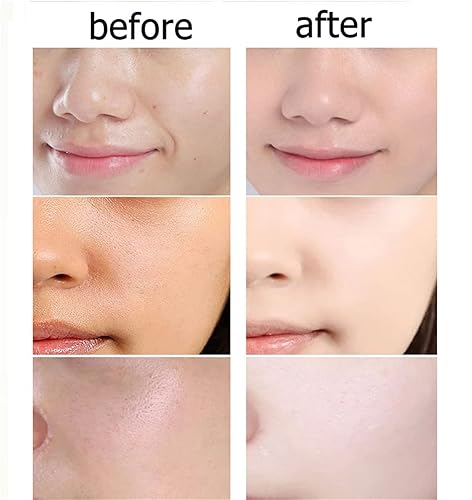 Miniatura 5 de znvwki Hilos Tensores Para El Rostro, Hilos de Colageno Absorbibles para la Cara, Acido Hialuronico Puro Para Rostro, Hilo Proteína Soluble Coreana