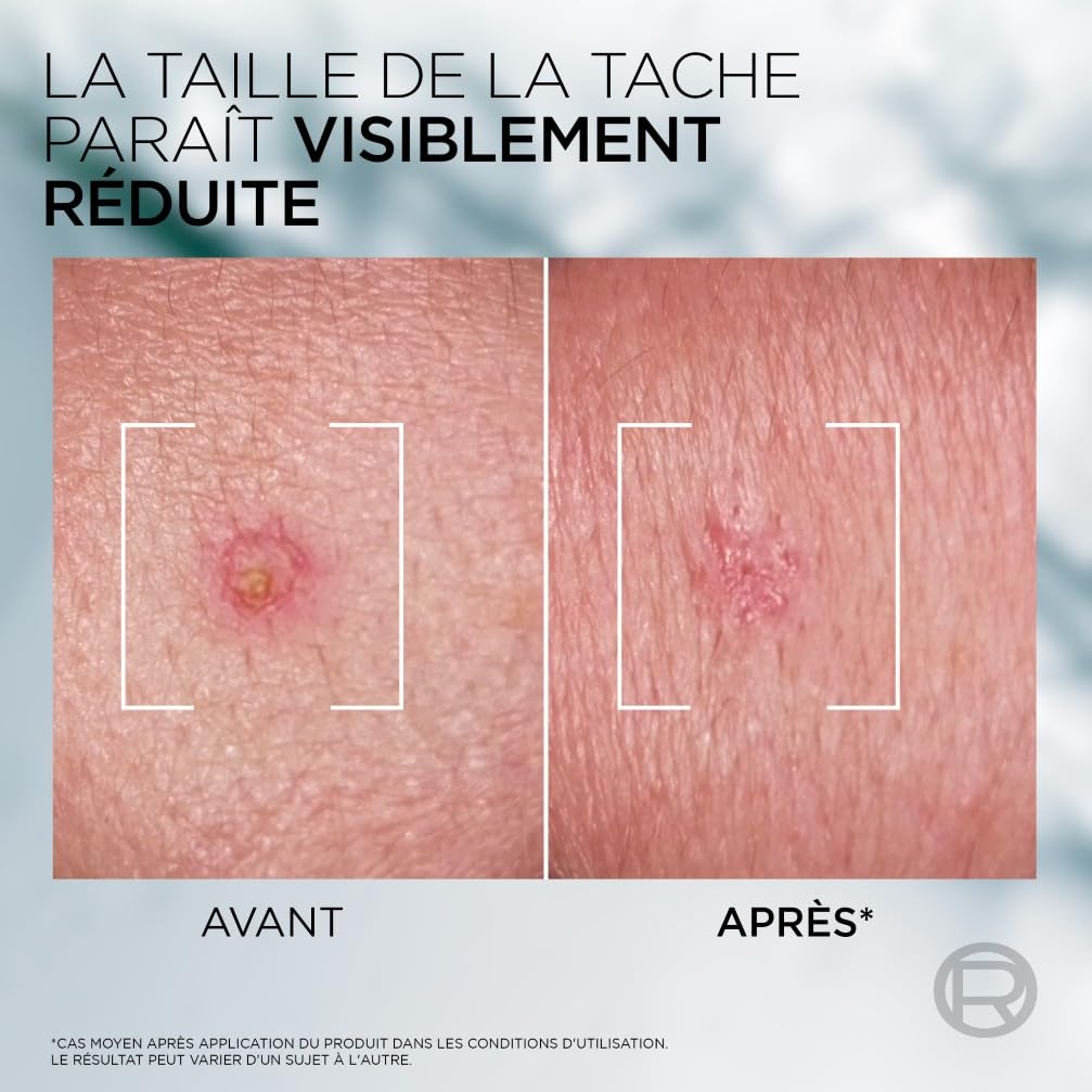 L'Oréal Men Expert - Pâte S.O.S Anti-Imperfections - Soin Localisé Anti-Boutons et Masque Purifiant - Enrichie en Niacinamide et Acide Glycolique - Derma Control - 45 ml