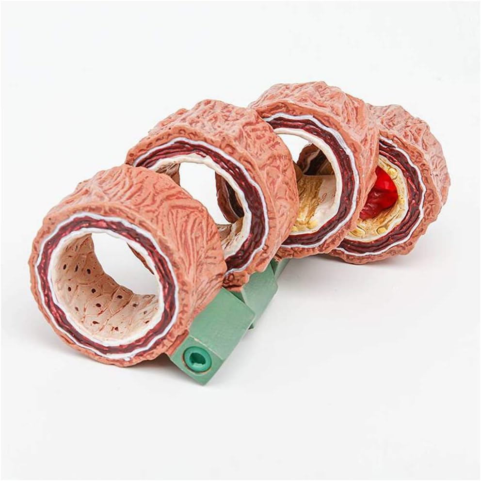 Modèle d'artère avec athérosclérose AMITD pour visualiser les plaques - 4