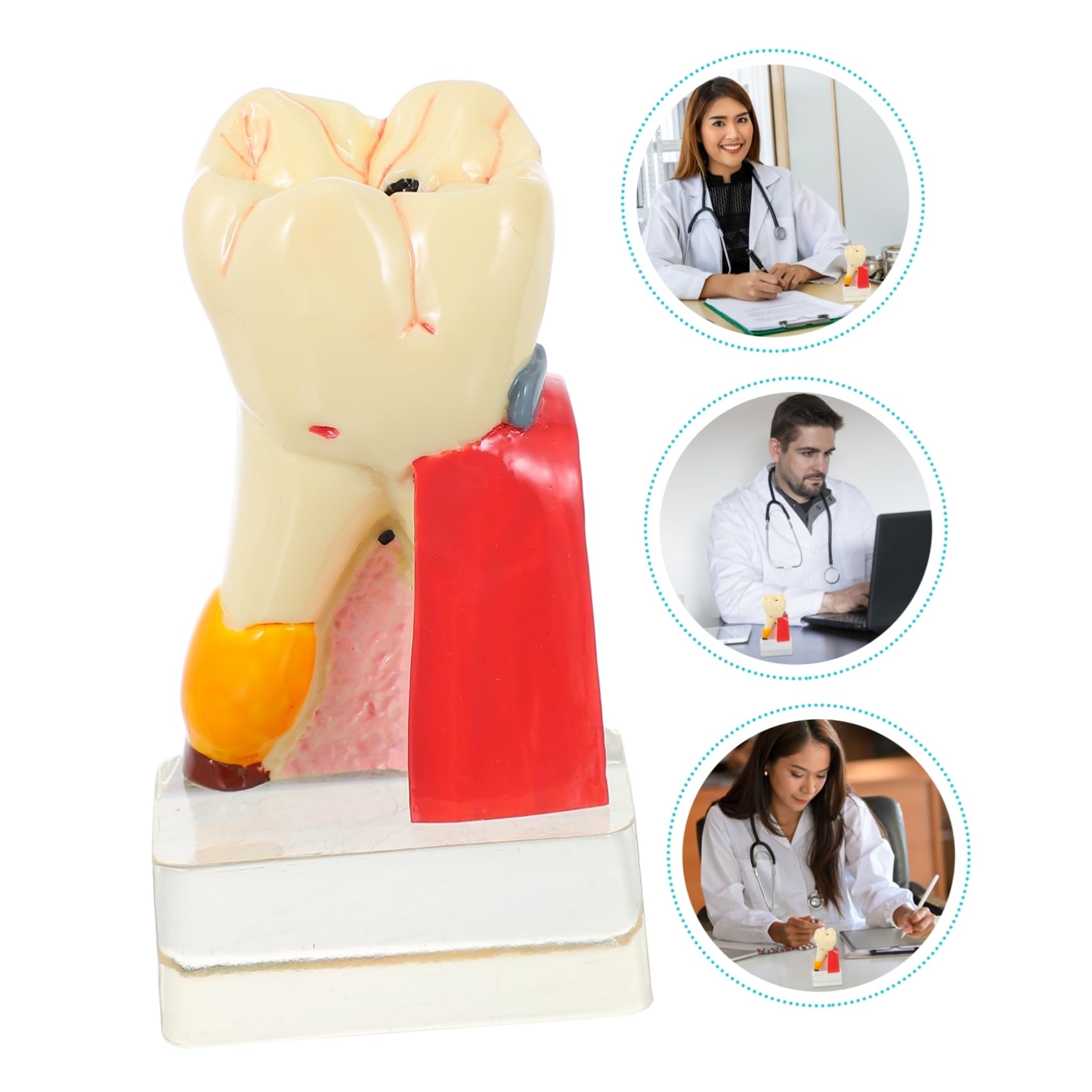 Modello di Carie Dentale in Resina Beige Leggero per Dimostrazione | Strumento Didattico Odontoiatrico, Modello Anatomico Denti per Studio, Materiale Resina
