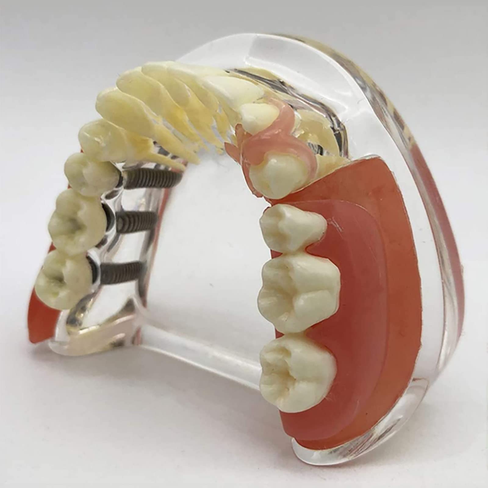 PEAMAN Modello di Cure odontoiatriche, Modello di impianto Dentale e restauro dei Denti a confronto con gengiva e Protesi Rimovibile per Lo Studio e la dimostrazione didattica