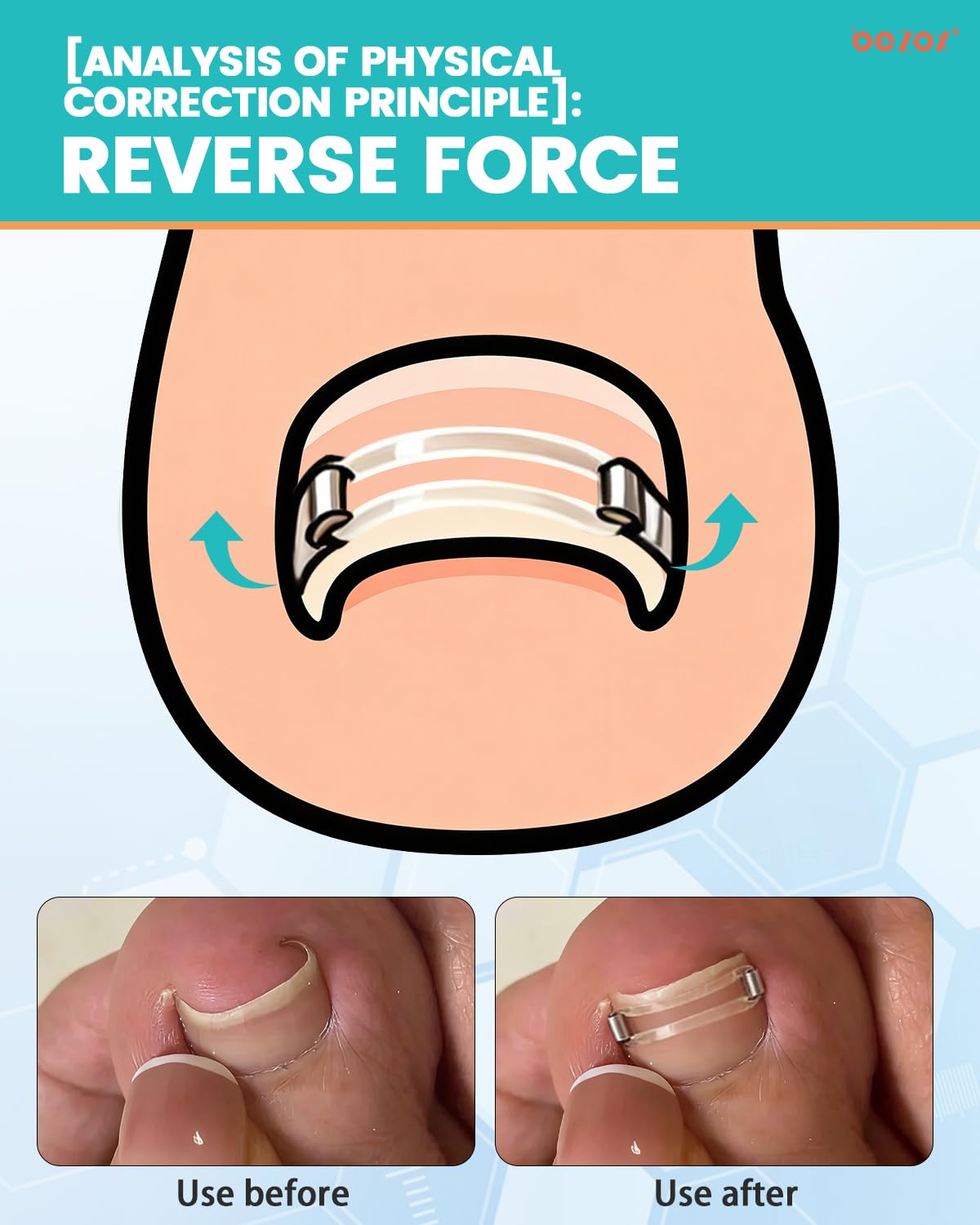 BEZOX Correcteur d'ongles incarnés, application facile à la maison