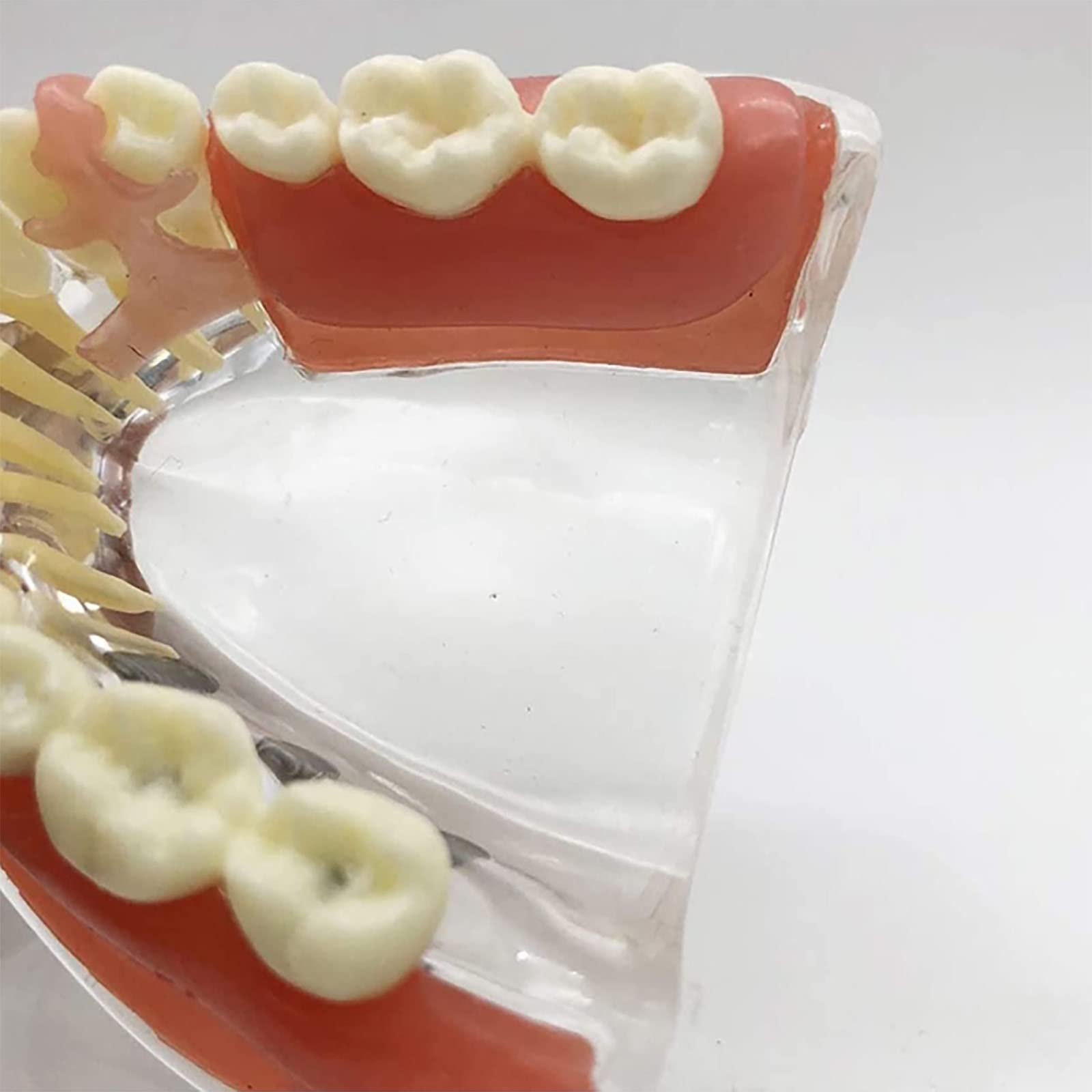 PEAMAN Modello di Cure odontoiatriche, Modello di impianto Dentale e restauro dei Denti a confronto con gengiva e Protesi Rimovibile per Lo Studio e la dimostrazione didattica