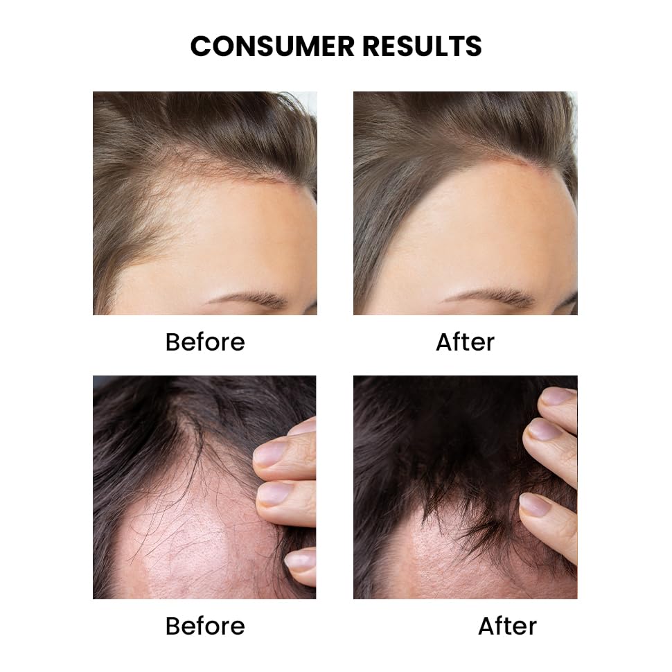 ThriveCo Rosemary Mint Hair Oil | For Hair Growth, Hair fall and Dandruff Control | Smoothens Dry Scalp & Split Ends | Suitable for both Men and Women |50ml - Image 4 thumbnail