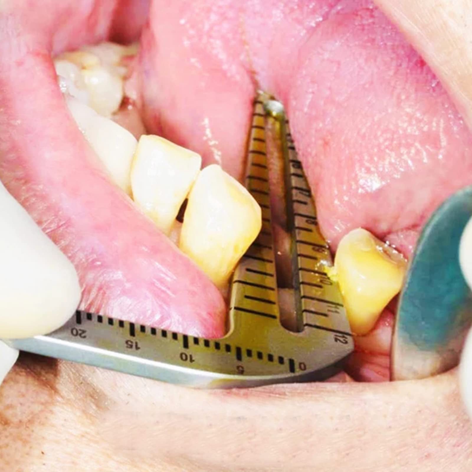 Guida All'impianto Dentale Impostare Oral Piantatura Posizionamento Guida Di Posizionamento Guida Per La Perforazione Posizionamento Del Righello Angolo Righello Strumenti Dell'impianto Dentista