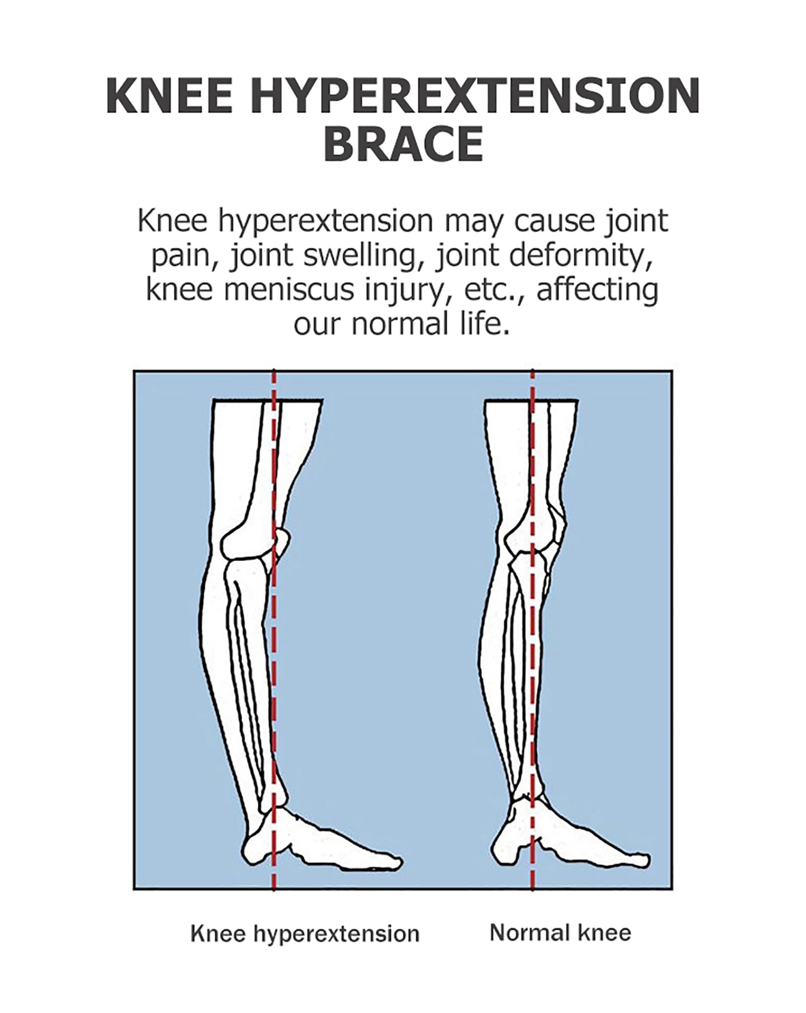 Soporte para Rodilla, Rodilla para artrosis, osteoartritis, Necrosis avascular, Alivio de la articulación de la Rodilla B on B, inmovilizador de Rodilla Ajustable