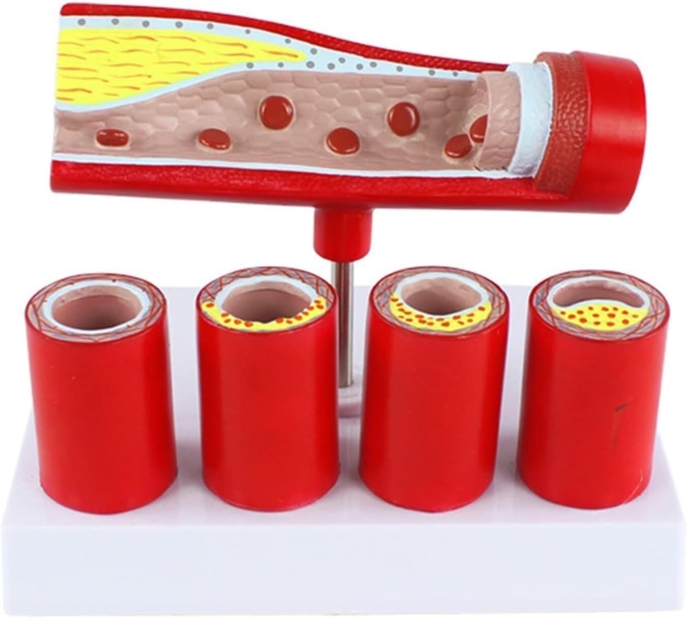 Modèle de type artère coronaire de l'artère cardiovasculaire, modèle d'anatomie de thrombose de formation de sclérose d'artère de branche âgée, démontrant les 4 étapes de l'athérosclérose