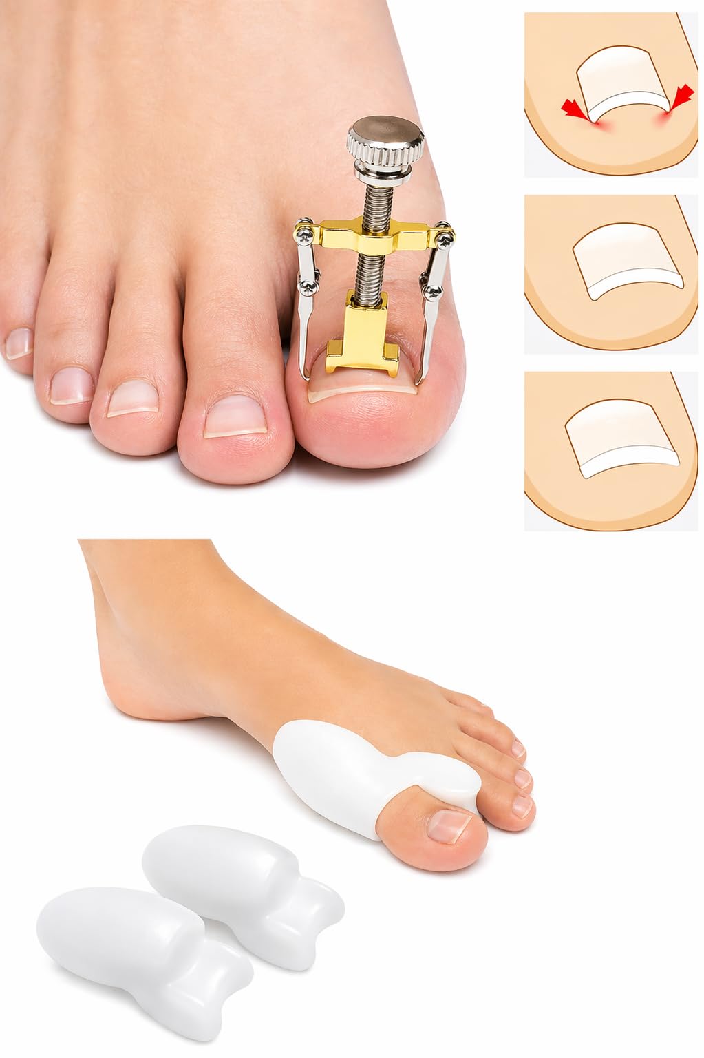 Combo Pack of 3 pieces One Toe Nail Correction Tool With Two Pieces Toe Bunion Corrector Bunion Relief Protector Sleeves Kit Treat Pain in Hallux Valgus Tailors Big Toe Joint Hammer-image-18