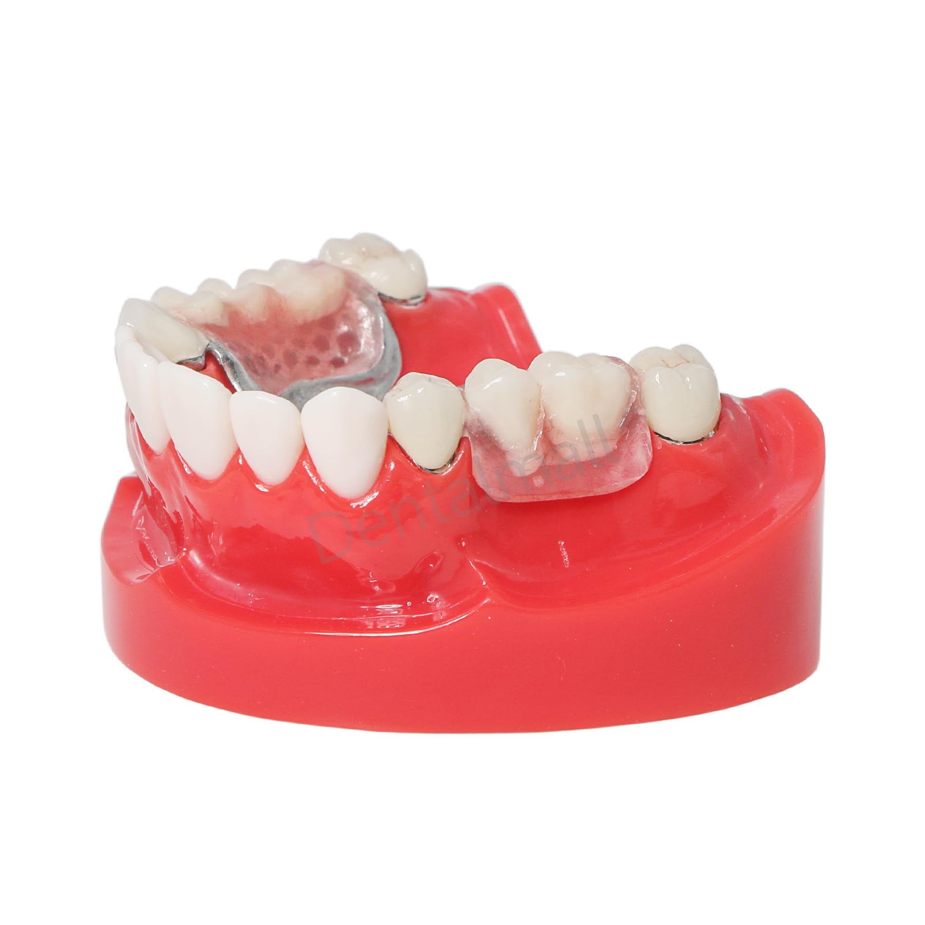 Dental Overdenture Typodont Model Lower Jaw Representing Telescope Crown M6010