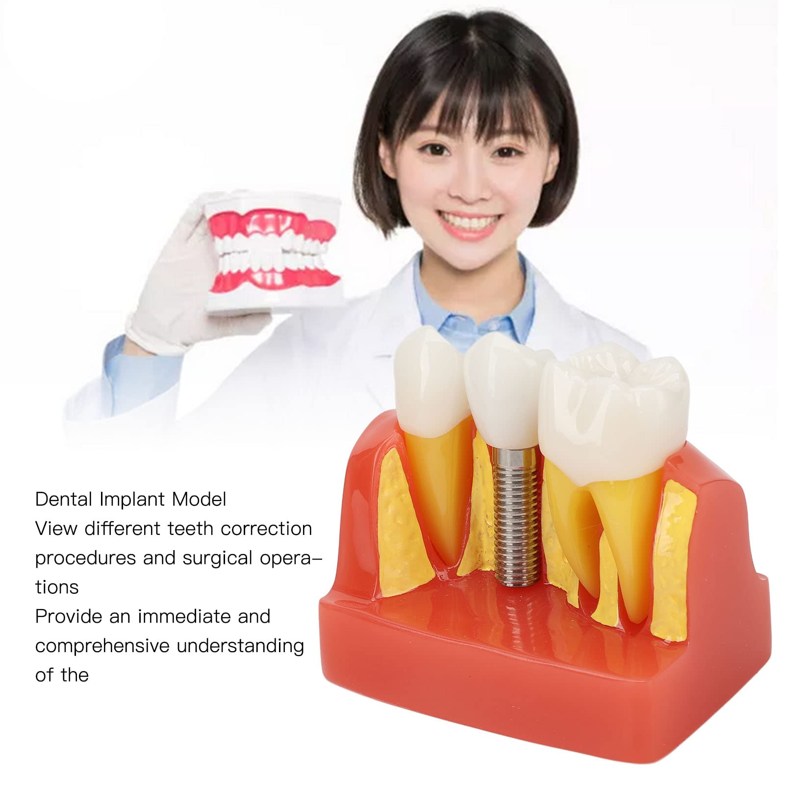 Modelo de implante Dental con Corona y Puente extraíbles para demostración y formación