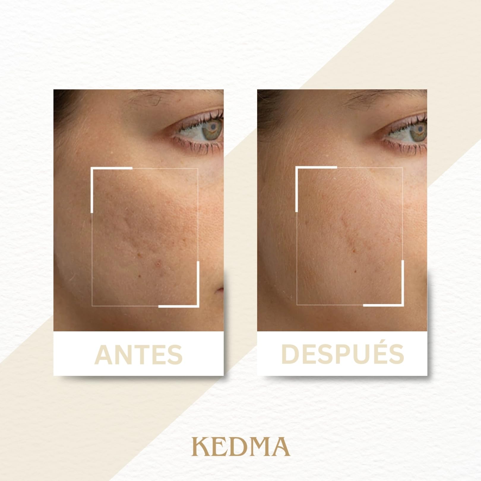 KEDMA - Mascarilla Facial Iluminadora para Piel Apagada & Manchas - 50ml | La mascarilla con caolín, ácidos de frutas y vitamina C purifica y ayuda a iluminar la piel apagada.