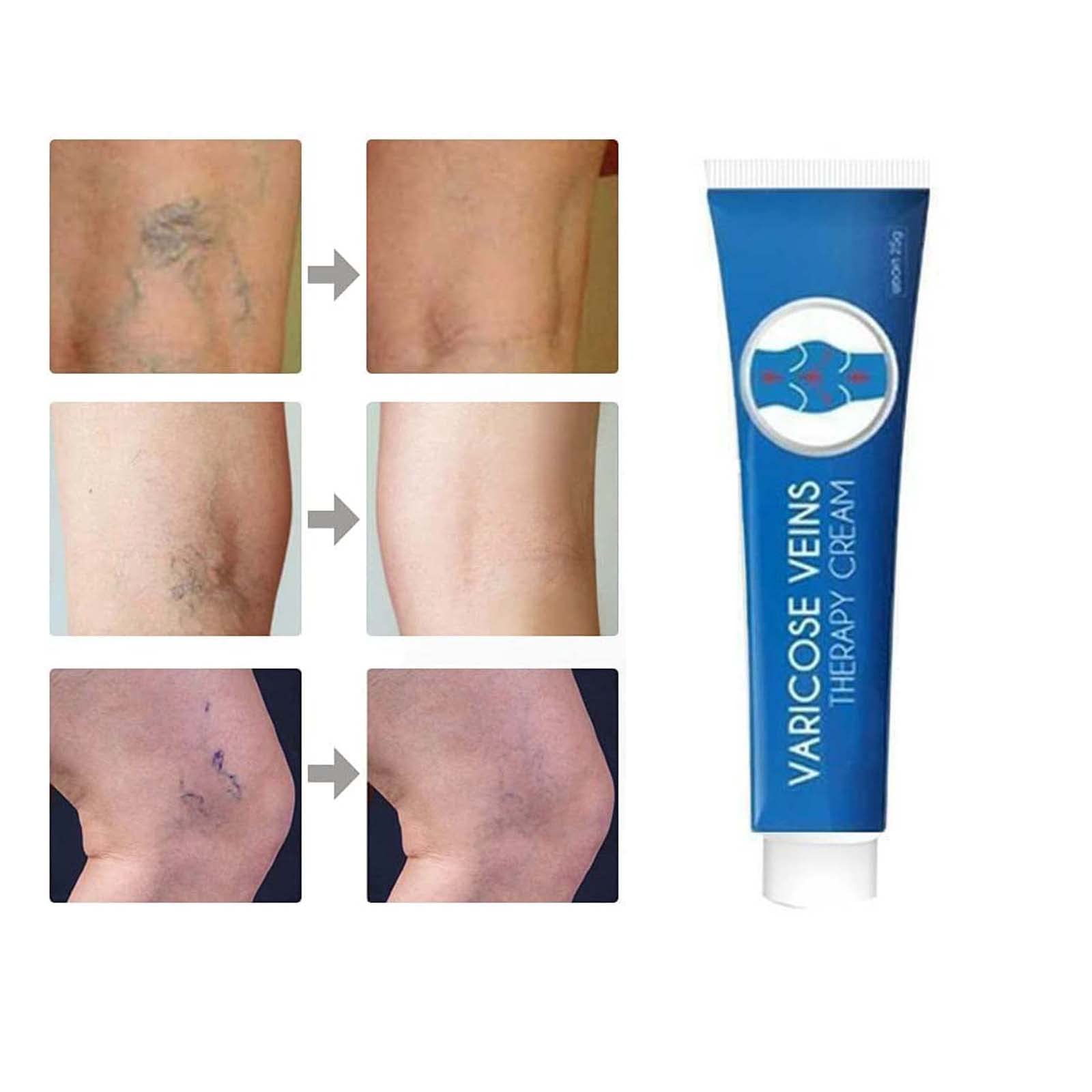 Blue Light Therapy Varicose Veins Pen/Cream - Soft Scar Removal Set. (Varicose Vein Cream)