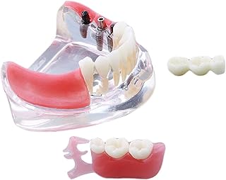 Dental Study Model Anatomical Model, Dental Implant Restoration Model Teaching Study Teeth Model, Teeth Missing Model Silicon Rubber Upper Jaw Demo Model