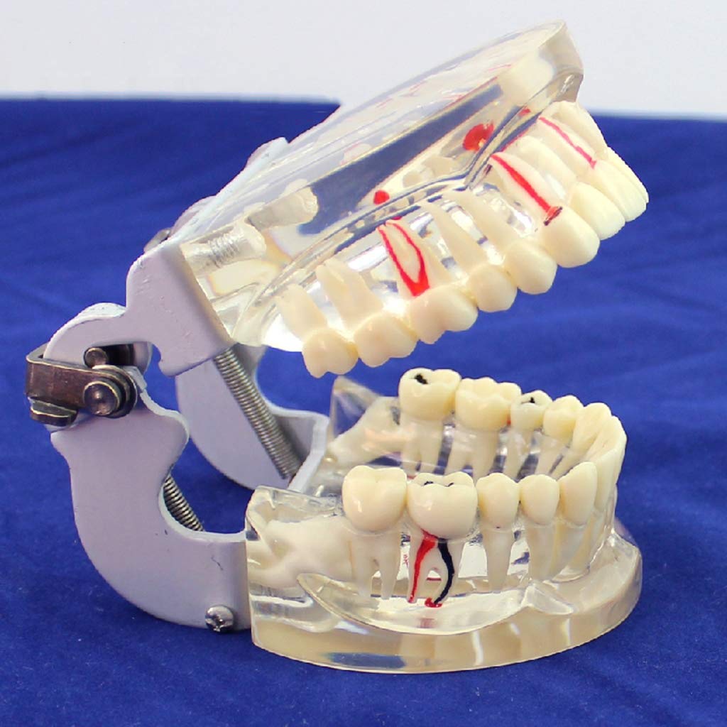 Sjdopulse Dental Implant Disease Teeth Model - Dental Teeth Implant Model - Transparent Adult Comprehensive Oral Pathology Demonstration Model - For Medical Educational Training Aid