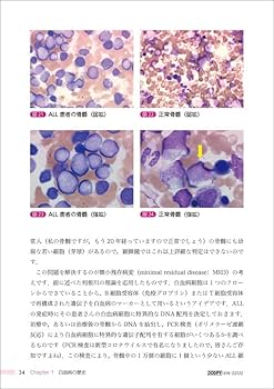 小児白血病の世界―病態の解明から治療まで | 真部 淳 |本 | 通販