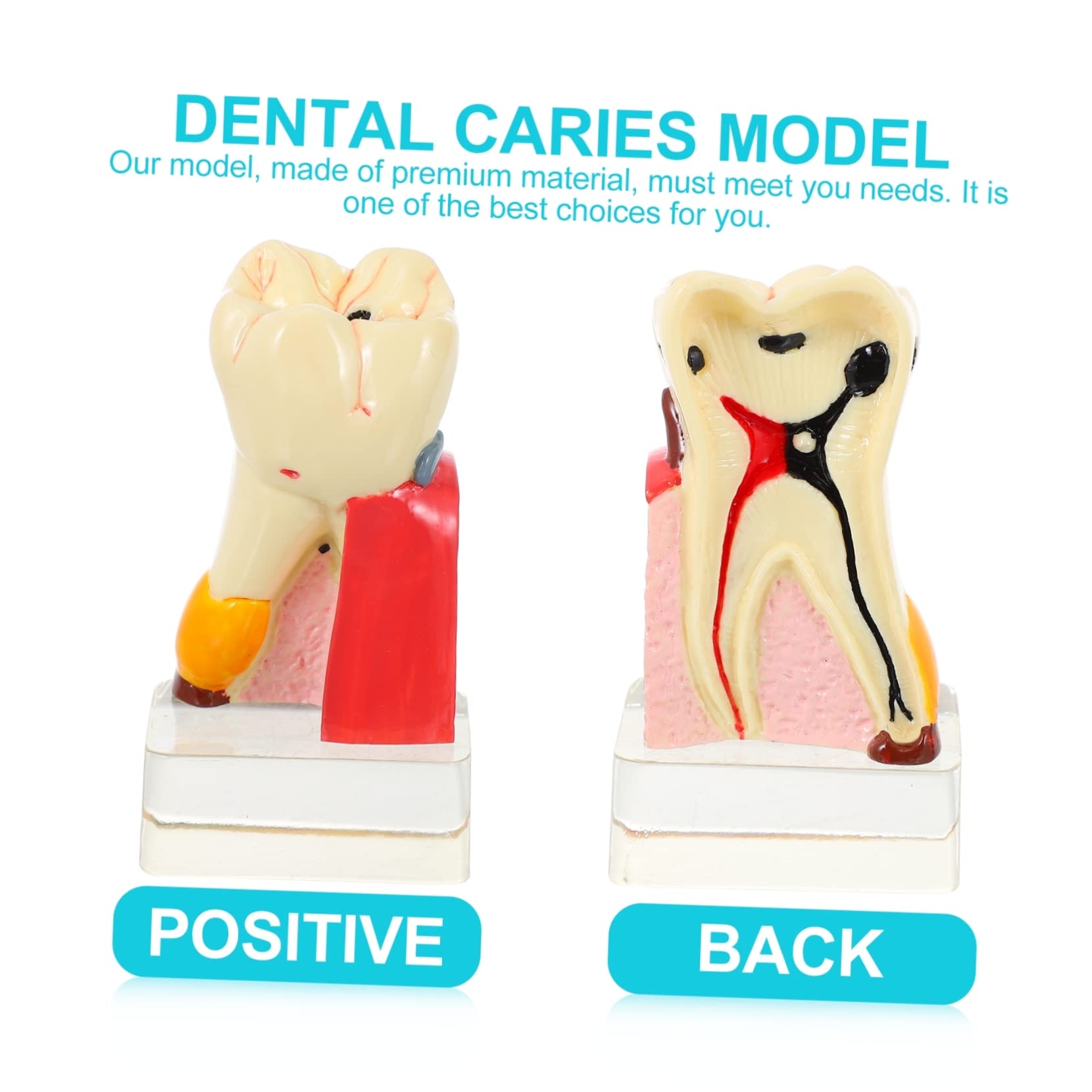Alipis 4volte Modello di Carie Modello Anatomico di Carie per Studio e Ricerca Odontoiatrica Leggero e Portatile