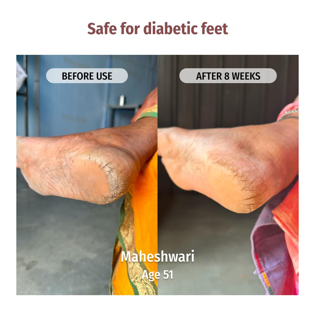 Vilvah Foot Cream for Cracked Heels | Repairs Dry, Rough & Damaged Feet | Softens Calluses & Removes Dead Skin | Deep Hydration & Odour Control | 100ml 2