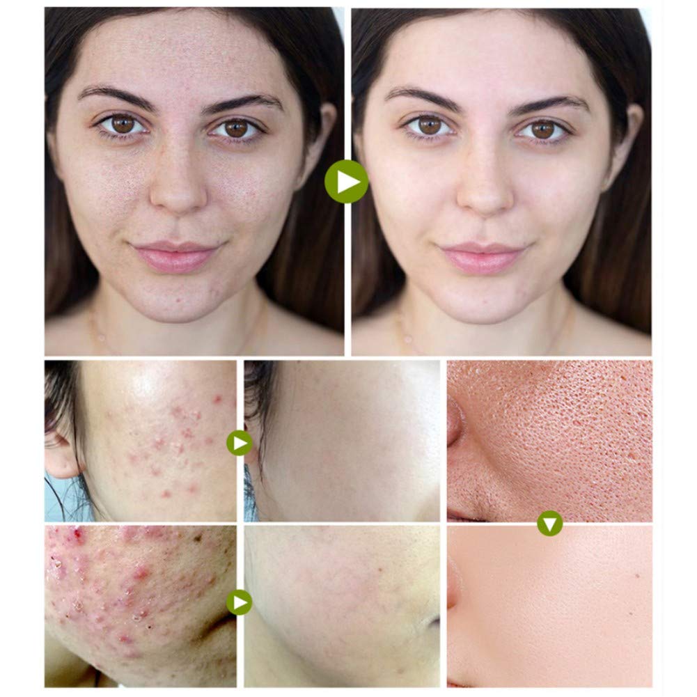 Reparación del acné cicatrices Crema antiacné facial Crema antiacné Crema antiacné Pimple Oil Control Reencoger los poros Sérum Hidratante para la cara