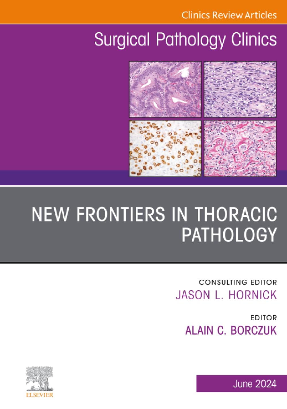 New Frontiers in Thoracic Pathology, An Issue of Surgical Pathology Clinics: Volume 17-2 (The Clinics: Surgery, Volume 17-2)