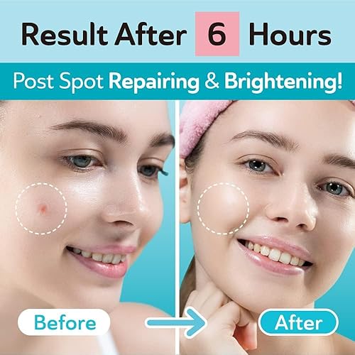 Miniatura 4 de Paquete definitivo para el cuidado del acné  Parches ultra invisibles para manchas oscuras post acné, parches de acné de ácido salicílico para acné