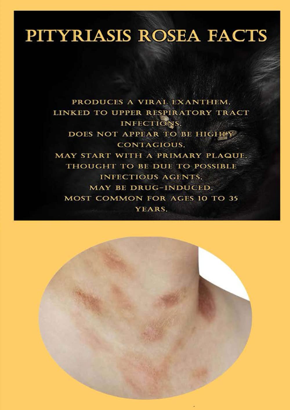 Pityriasis Rosea Facts : Pityriasis Rosea – HEMBQ