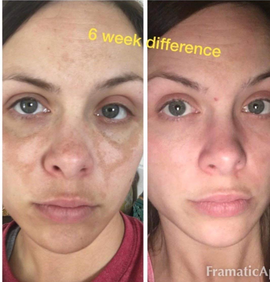 2 Hydroquinone Helps Fade Dark Spots & Melasma This Will Provide You