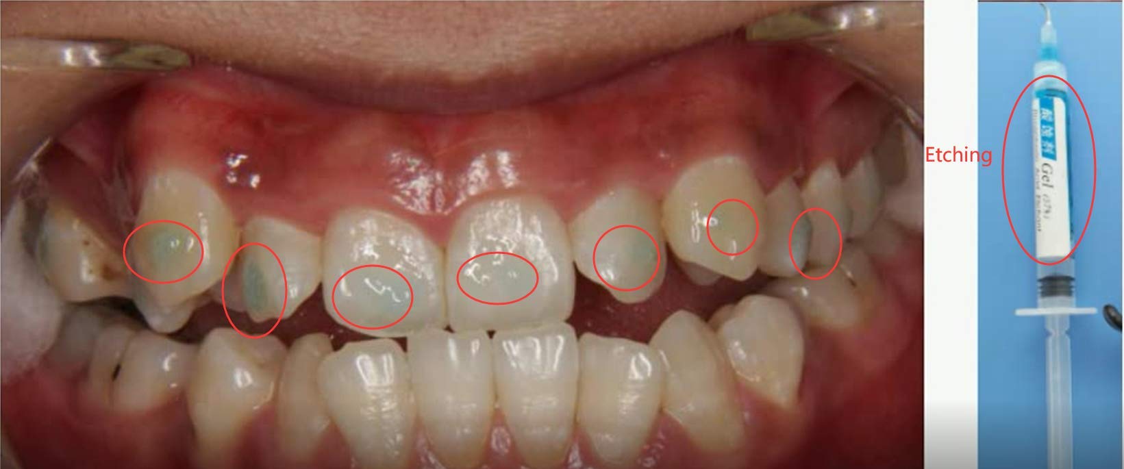 Sino Dental Orthodontic Brackets Glue Braces Bonding Light Cure