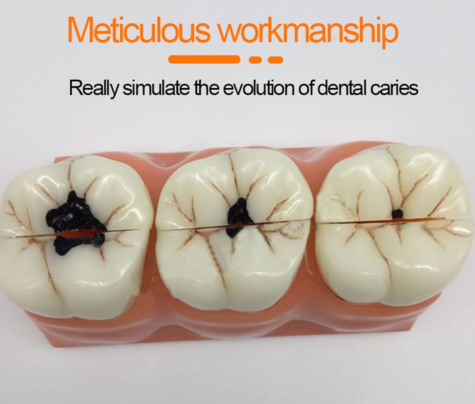 歯牙模型　3種類　別売り可 Amazon.co.jp: 取り外し可能歯列模型 齲蝕歯型模型 樹脂素材 歯