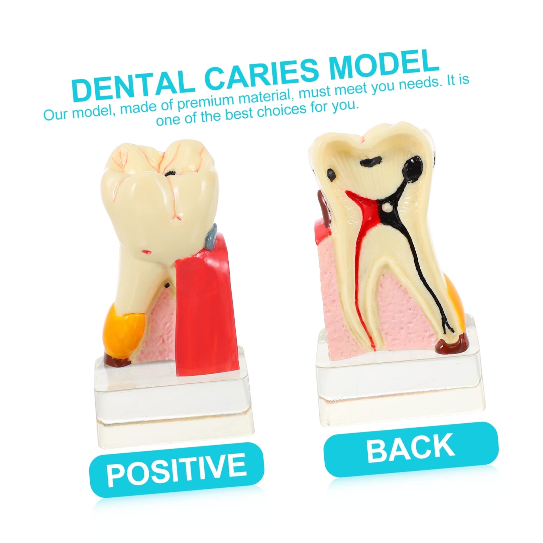 Modello di Carie Dentale in Resina Beige Leggero per Dimostrazione | Strumento Didattico Odontoiatrico, Modello Anatomico Denti per Studio, Materiale Resina