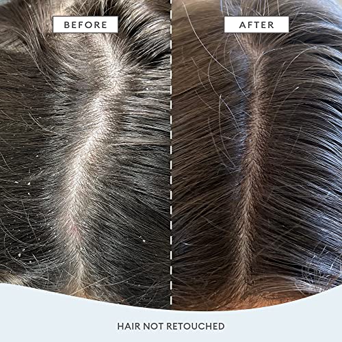 Briogeo Scalp Revival Megastrength+ Dandruff Shampoo | Charcoal + Aha/Bha With Salicylic Acid 3%| Anti-Dandruff Shampoo To Soothe A Dry, Flaky, Itchy Scalp | Vegan, Phalate & Paraben-Free | 8.4 Ounces #TOP1