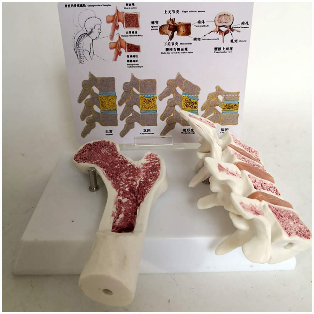 WlP Femur Osteoporose Modell - Anatomie Oberschenkelknochen 20x12x10cm