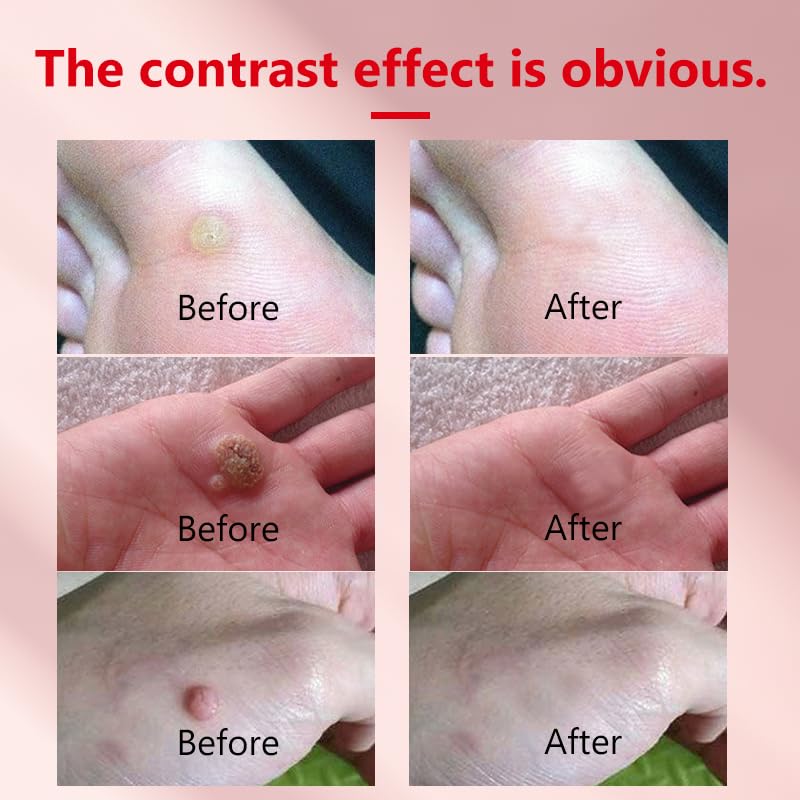 Image of Wart Remover 20g, Effective Verruca Treatment, Corns Spot Moles, Moles and Calluses, Suitable for The Face and Body, Skin tag Remover, to Prevent The Spread of Wa