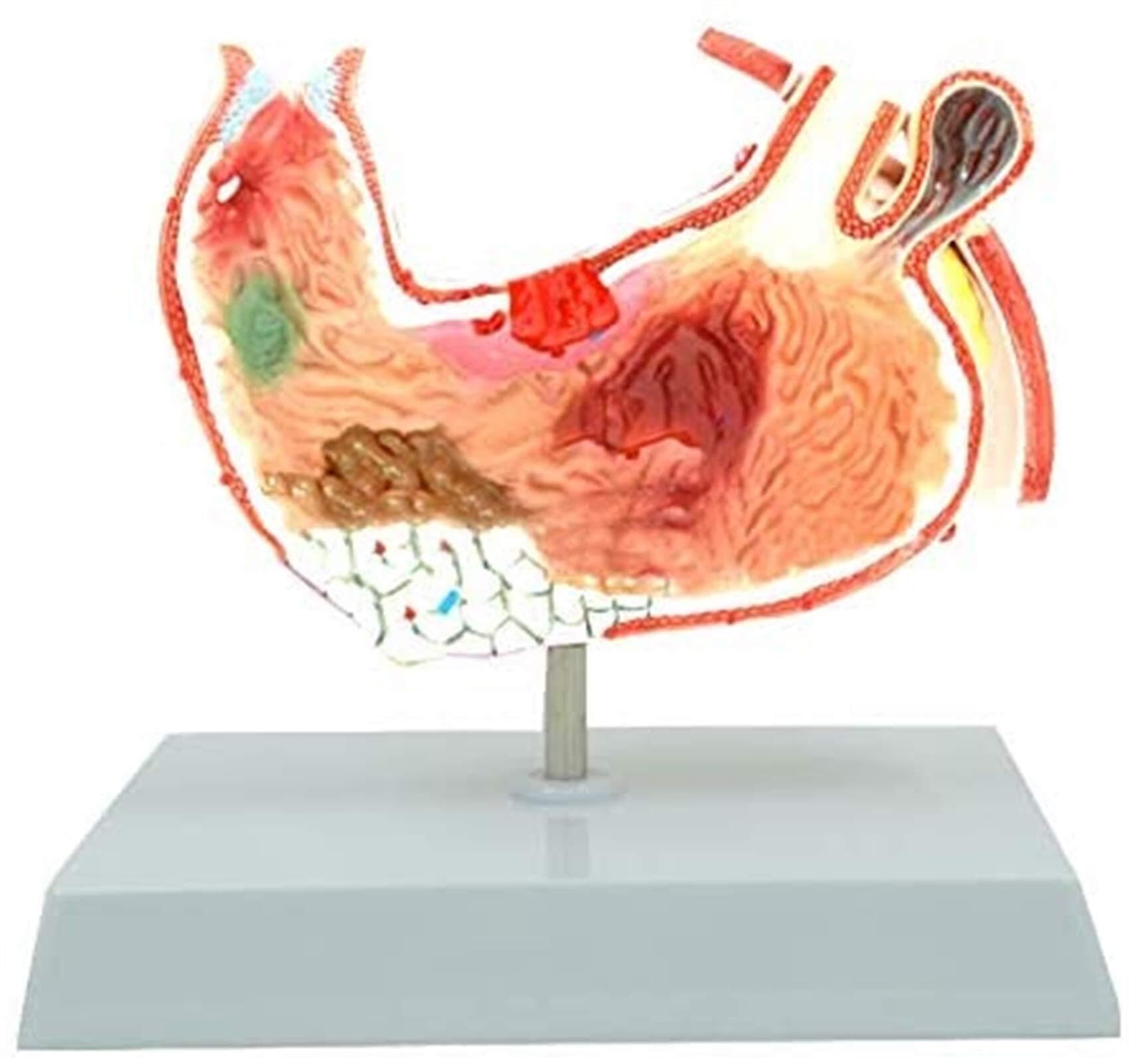 XINGLUOY Gastric pathology model Human stomach anatomy