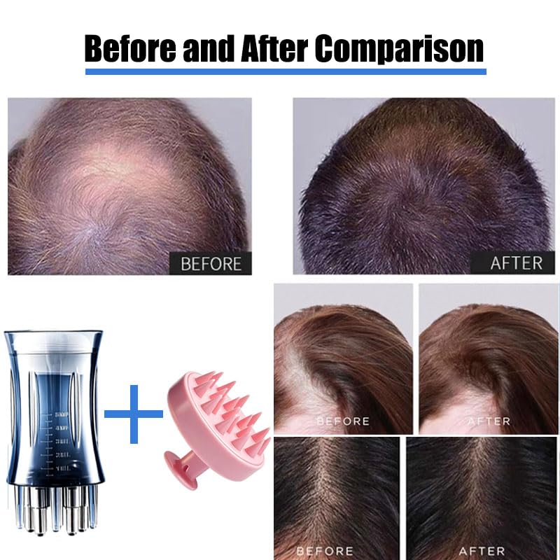 2Pcs Hair Oil Applicator Set-Stainless Steel Minoxidil Applicator Bottle