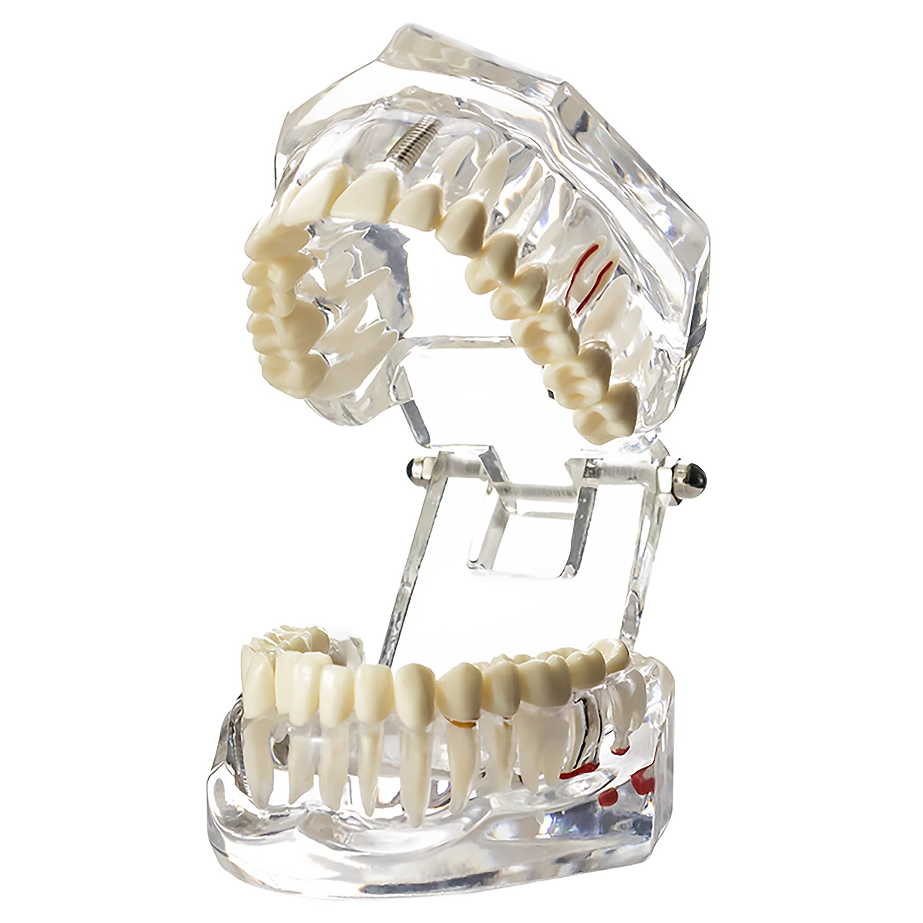 Modèle Typodont Pour Restauration D'implant Dentaire Avec Noyau Et Bridge, Réf. M6024