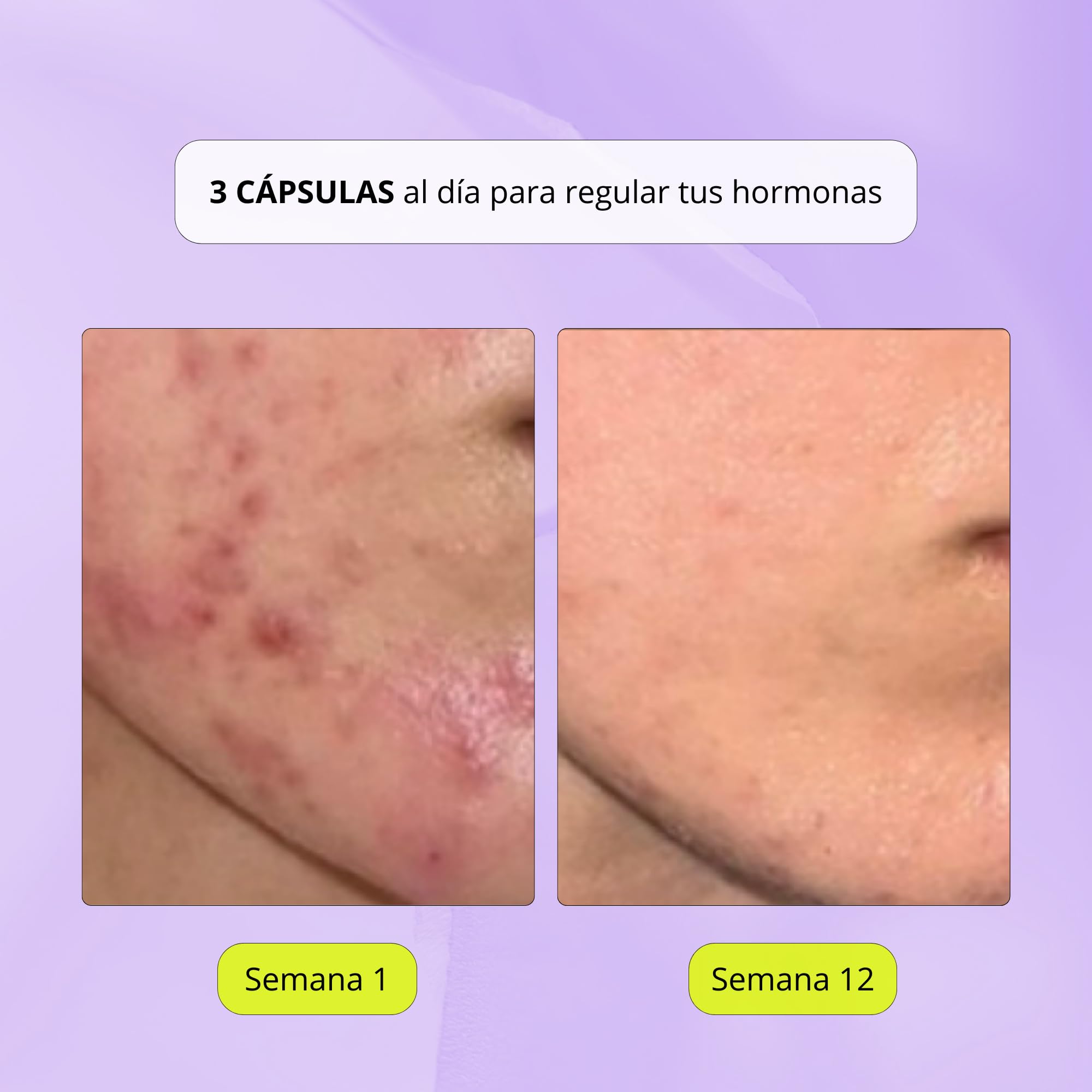Myo-Inositol + Zinc + Berberina - 11 Activos - Trata el Acné Hormonal | Equilibrio Hormonal Femenino - para Ciclos Irregulares y SOP - Reduce Caída del Cabello - 90 cápsulas | Nonna Cosmetics