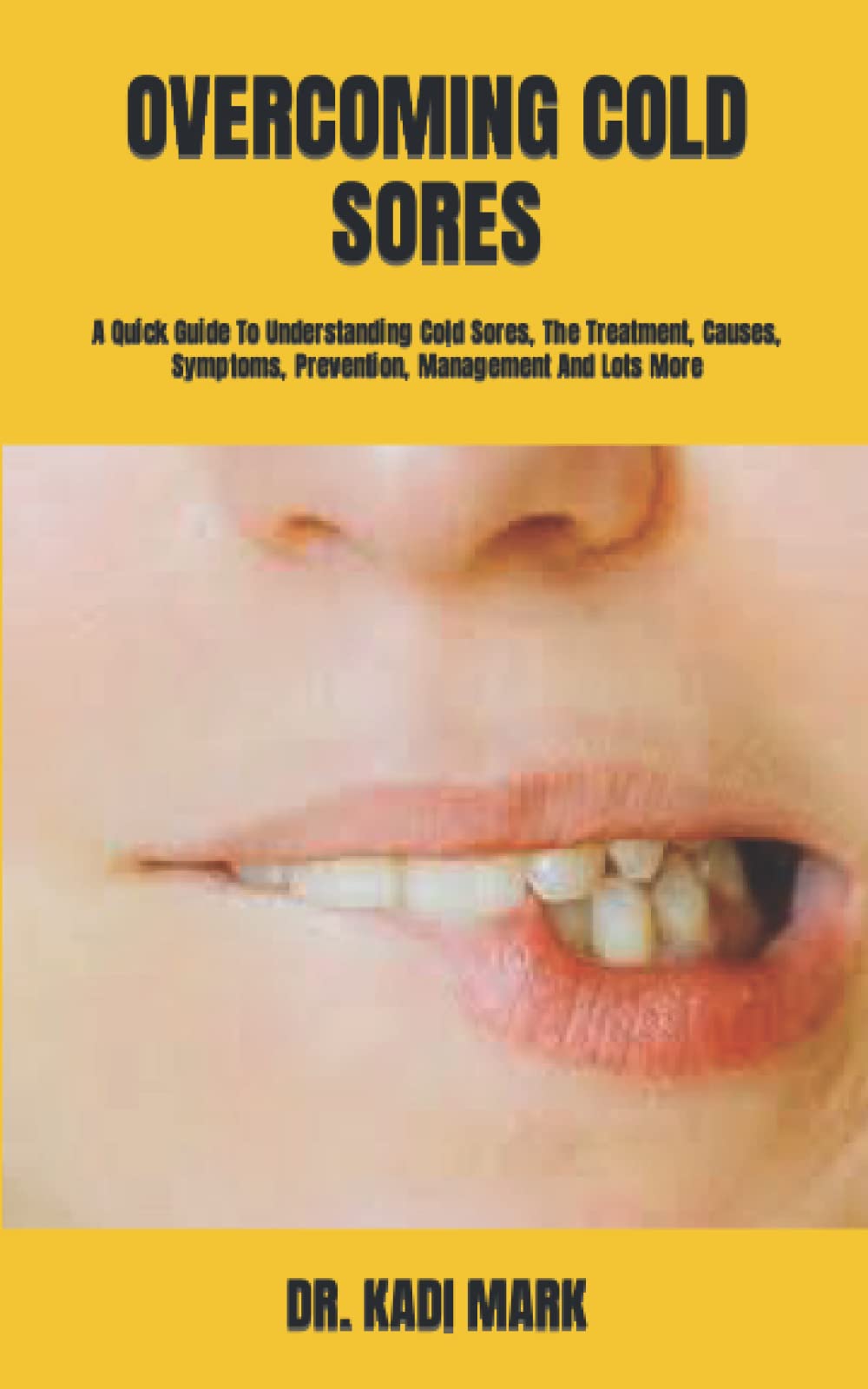 Buy COLD SORES A Quick Guide To Understanding Cold Sores