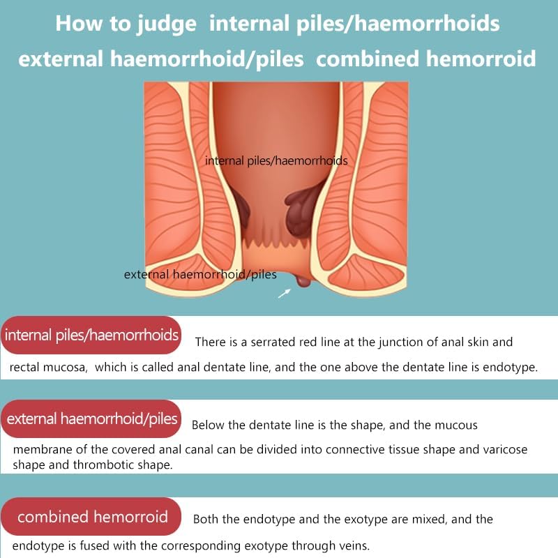 Hemorrhoid Cream for Men and Women, with Lidocaine and Phenylephrine HCl, Provides Fast Relief from hemorrhoid discomfort. Naturally formulated for Hemorrhoids and fissures (0.7 oz) - Image 4