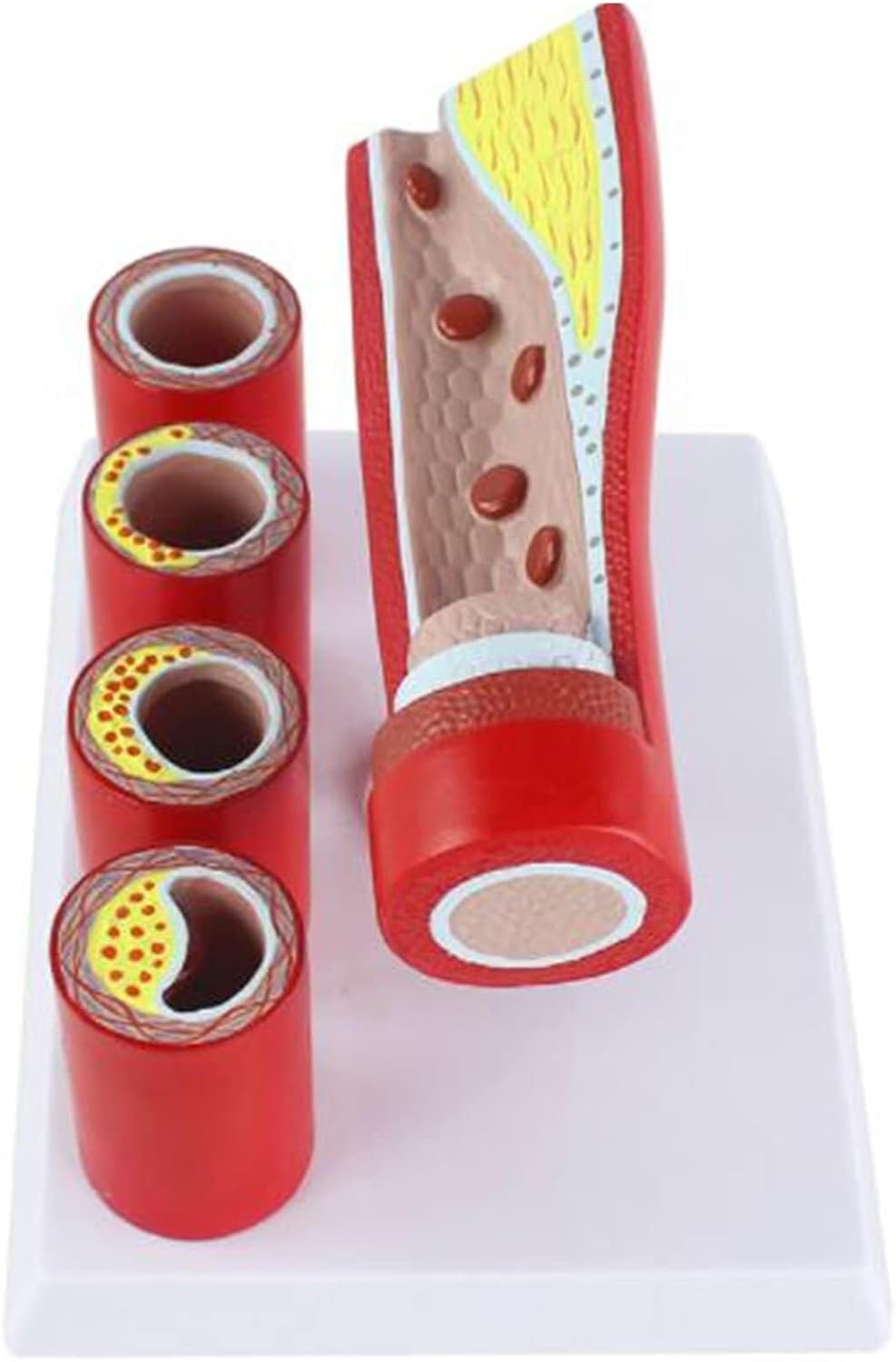 3D臓器モデル・冠動脈モデル｜3D臓器モデル・スタンダード臓器モデル｜株式会社クロスメディカル 心血管動脈冠動脈様モデル人体教育病理血管解剖モデル -  加齢枝動脈硬化形成血栓モデル - 研究モデル冠動脈