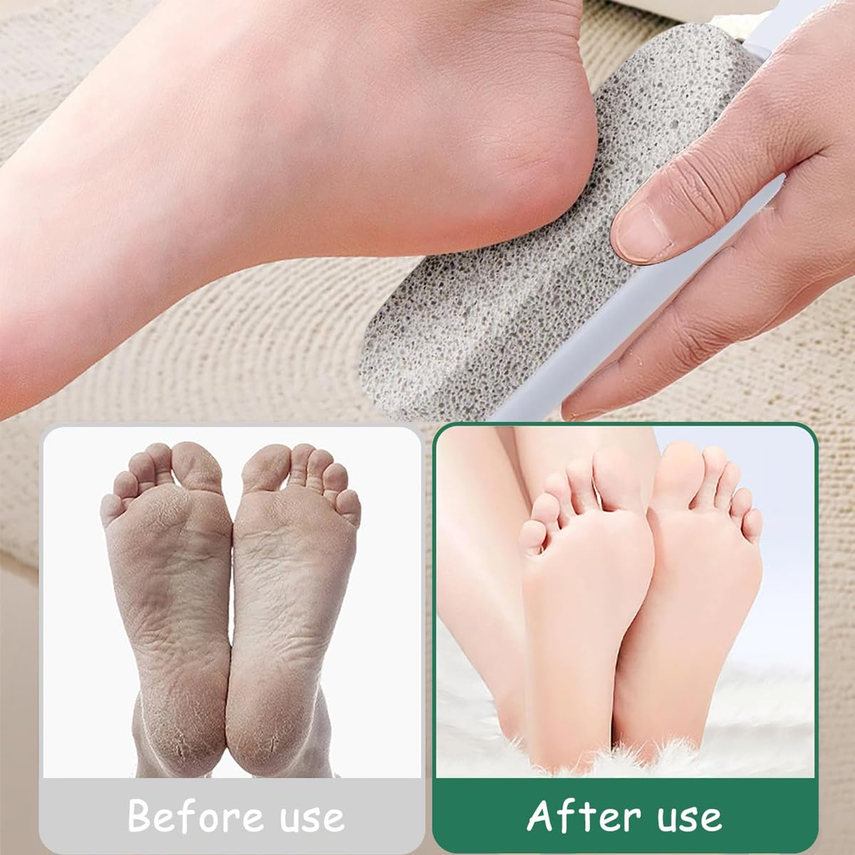 Ludom Lima para el cuidado de los pies de piedra pómez de 2 piezas adecuada para hombres, mujeres, pelado, callos, callos