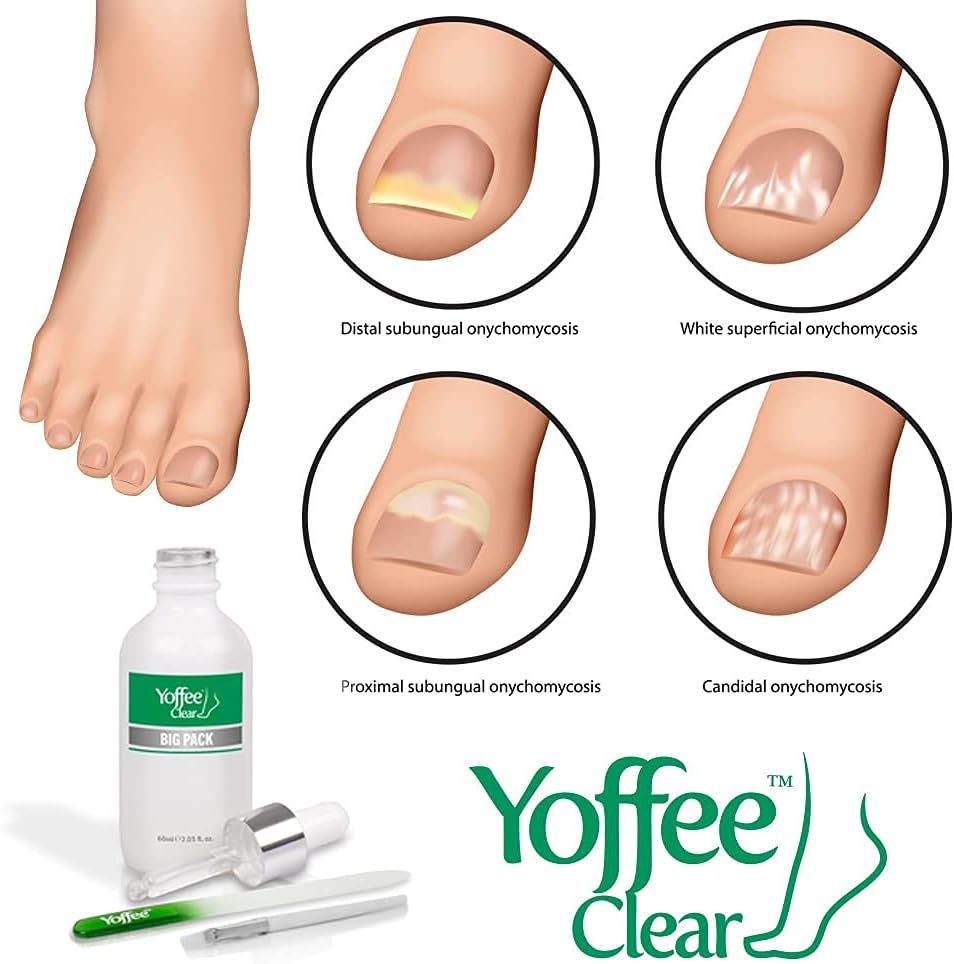 Yoffee Clear Nail Care Kit, Fungal Nail Treatment for Finger and Toe Nail, Antibacterial Nail Repair, Antiseptic - Image 4